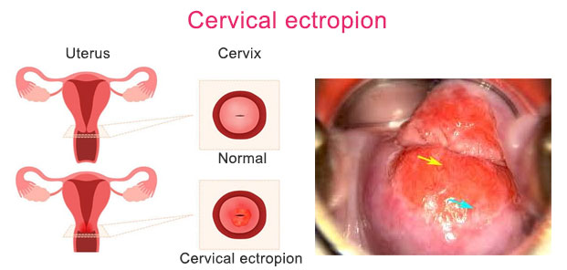 ectropion